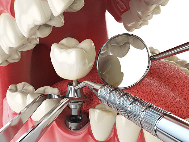Best Emergency Dental Extractions in Steelton, PA